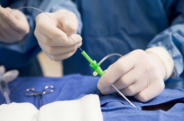sóng cao tần rfa tạo hình nhân nhầy đĩa đệm