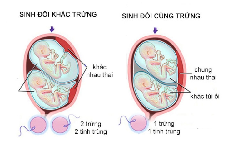 Lưu ý khi mang song thai