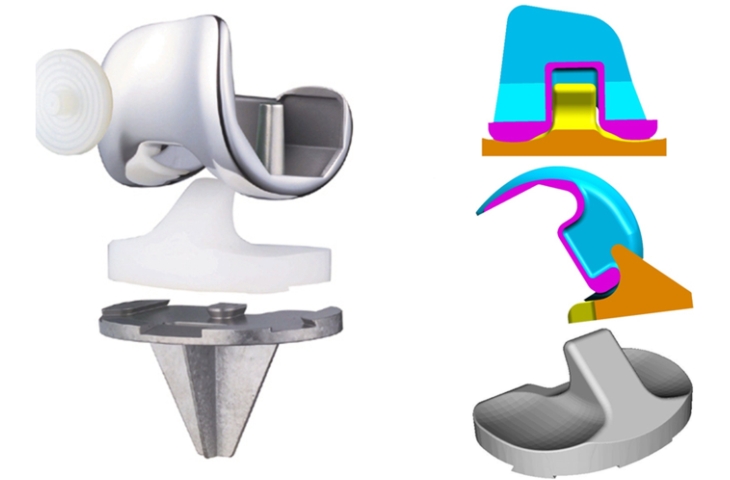 các loại khớp gối nhân tạo