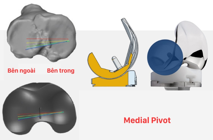 các loại khớp gối nhân tạo
