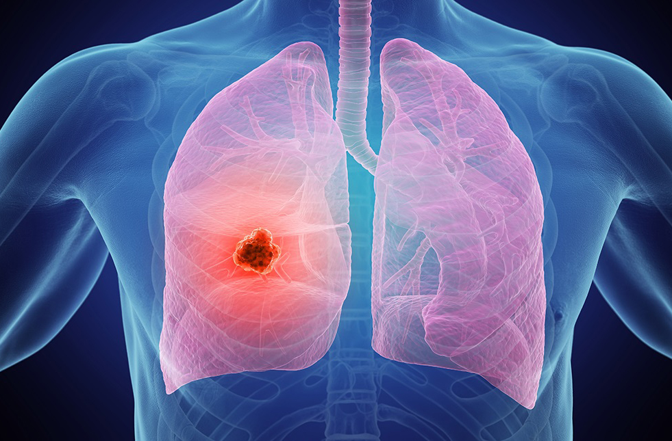 chụp CT phổi liều thấp