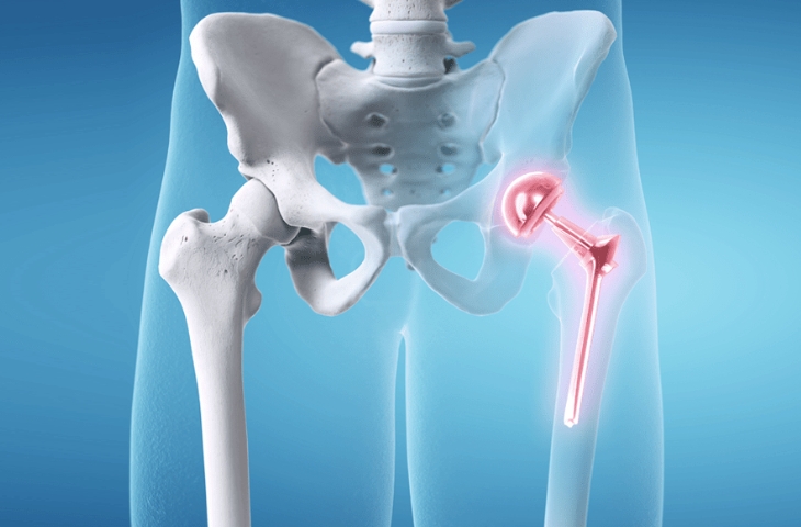 khớp háng nhân tạo