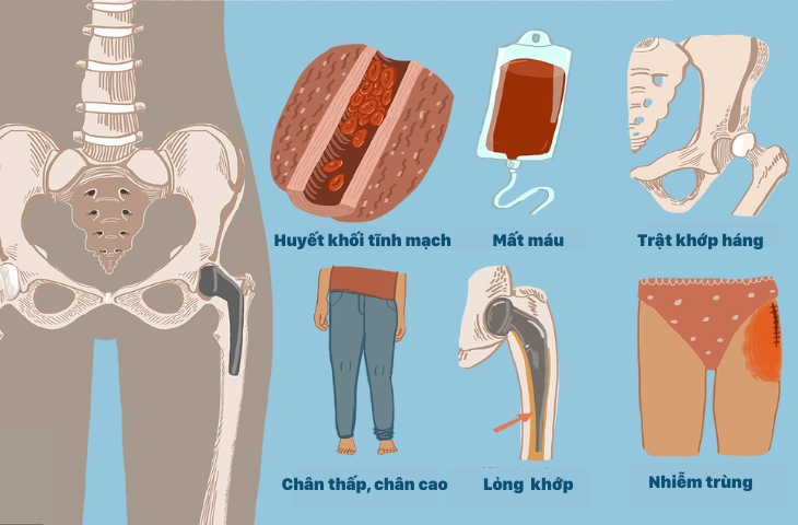 khớp háng nhân tạo