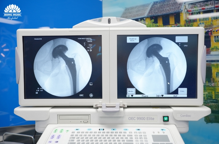 khớp háng nhân tạo