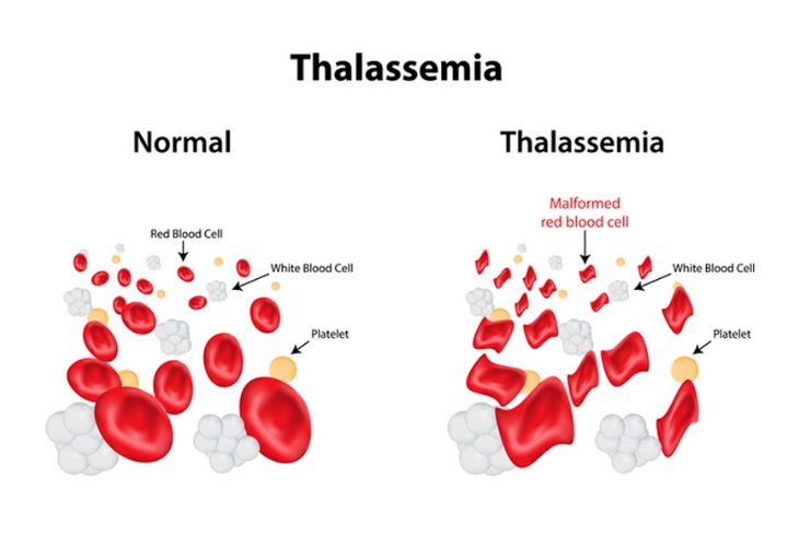 Thalassemia với thai kỳ
