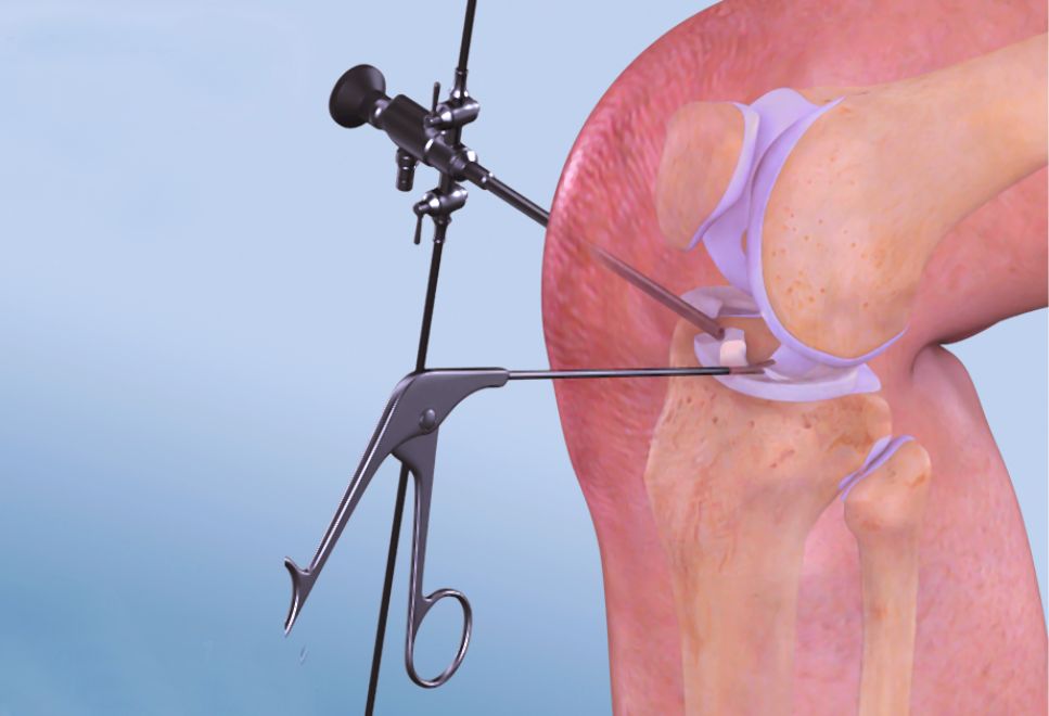 Phẫu thuật nội soi khâu sụn chêm rách