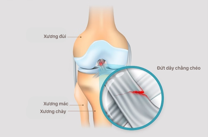 Rách dây chằng chéo trước