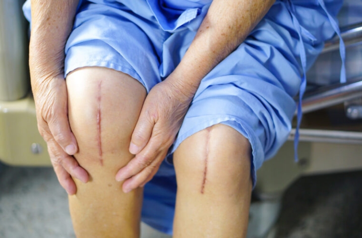 Đau khớp gối sau phẫu thuật tái tạo dây chằng chéo trước